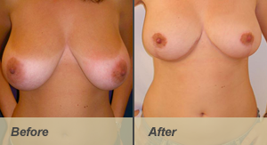 Breast reduction