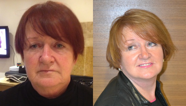 TBT facelift and necklift patient