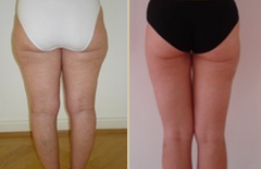 e-lipo, liposuction by Dr Kremer at Harley Street Aesthetics