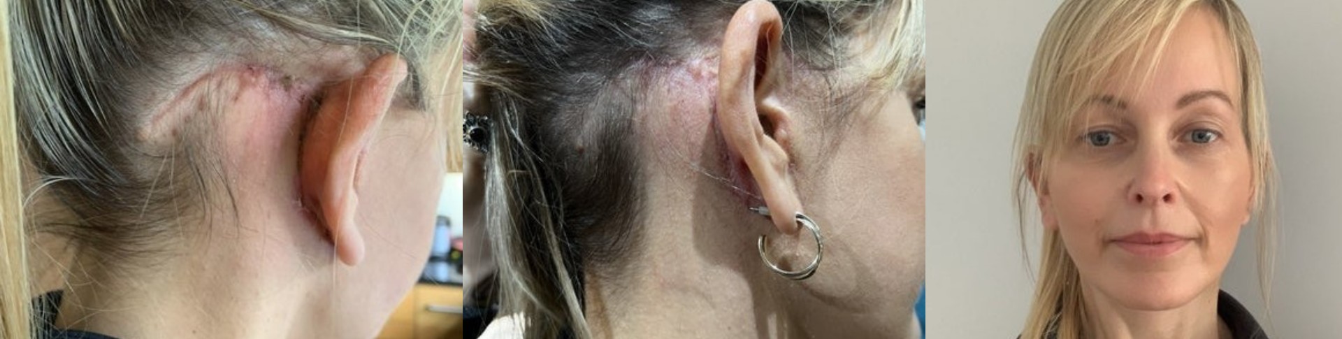 Scar healing behind ear after facelift surgery