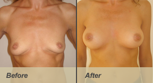 breast-augmentation