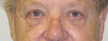 eye lift after surgery