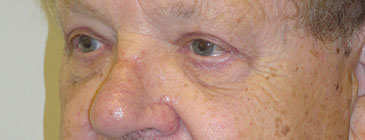 eye lift after plastic surgery