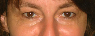 Munich eye lift before from front