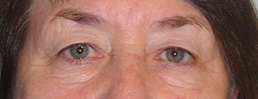 Maunder before eye lift 1