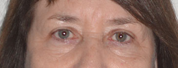 Maunder after eye lift 1