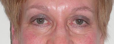 Jeffrey post eye lift 1