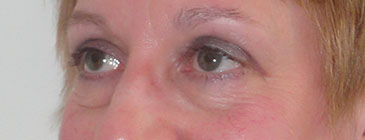 Jeffrey post eye lift 2