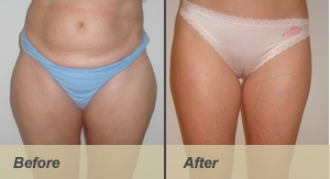 liposuction