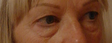 Lower TBT eyelift before