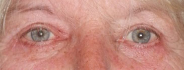 lower eyelift after