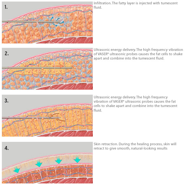 How Liposuction works