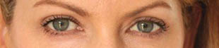 Turn Back time Eyelift: six months later Turn Back time eyelift: six months later