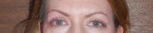 Blepharoplasty: after