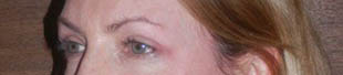 Blepharoplasty: after