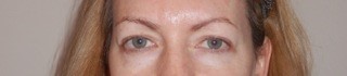 Blepharoplasty: before Blepharoplasty: before