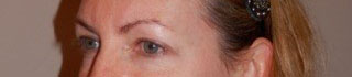 Blepharoplasty: before Blepharoplasty: before