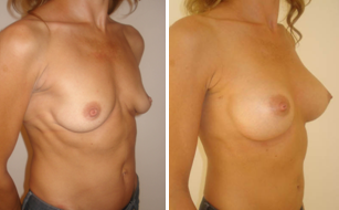 Comparison before-after split muscle breast augmentation