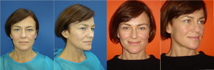 Before and after photos of a TBT Eyelift patient Before and after photos of TBT eyelift
